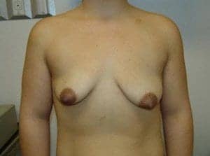 Before Image: Breast Lift - front