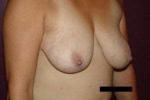 Before Image: Breast Lift - right-front-oblique