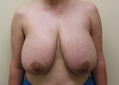 Before Image: Breast Lift - front