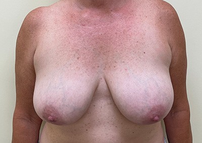 Before Image: Breast Lift - front