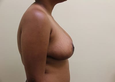 After Image: Breast Lift - right-side