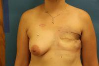 Before Image: Breast Reconstruction - front