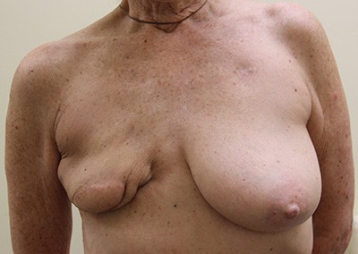 Before Image: Breast Reconstruction - front