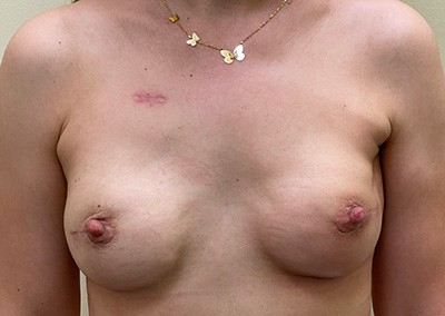 Before Image: Breast Reconstruction - front