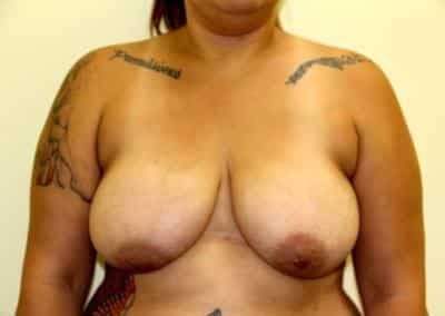 Before Image: Breast Reduction - front