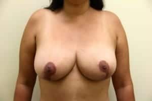 After Image: Breast Reduction - front