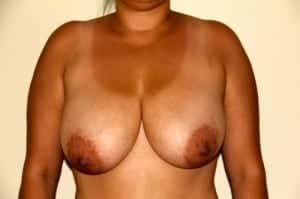 Before Image: Breast Reduction - front