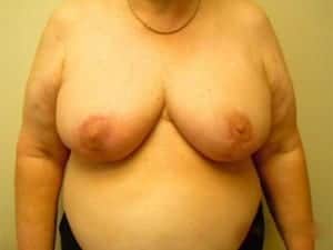 After Image: Breast Reduction - front