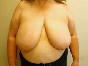 Before Image: Breast Reduction - front