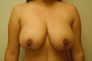 After Image: Breast Reduction - front
