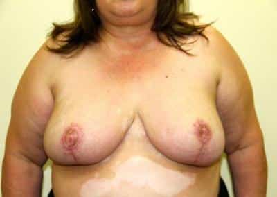 After Image: Breast Reduction - front