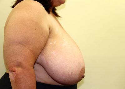 Before Image: Breast Reduction - right-side