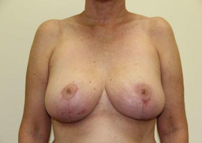 After Image: Breast Reduction - front