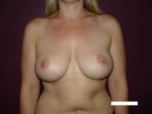 After Image: Breast Reduction - front