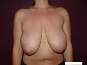 Before Image: Breast Reduction - front