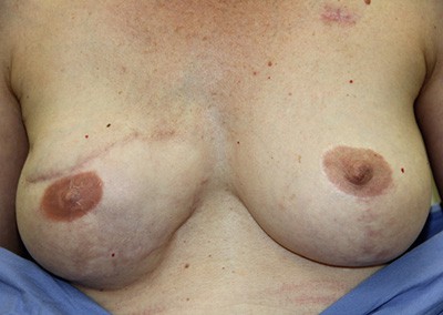 After Image: Breast Reduction - front