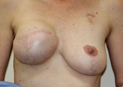 Before Image: Breast Reduction - front
