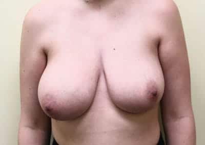 Before Image: Breast Reduction - front