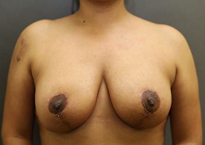 After Image: Breast Reduction - front