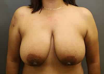 Before Image: Breast Reduction - front