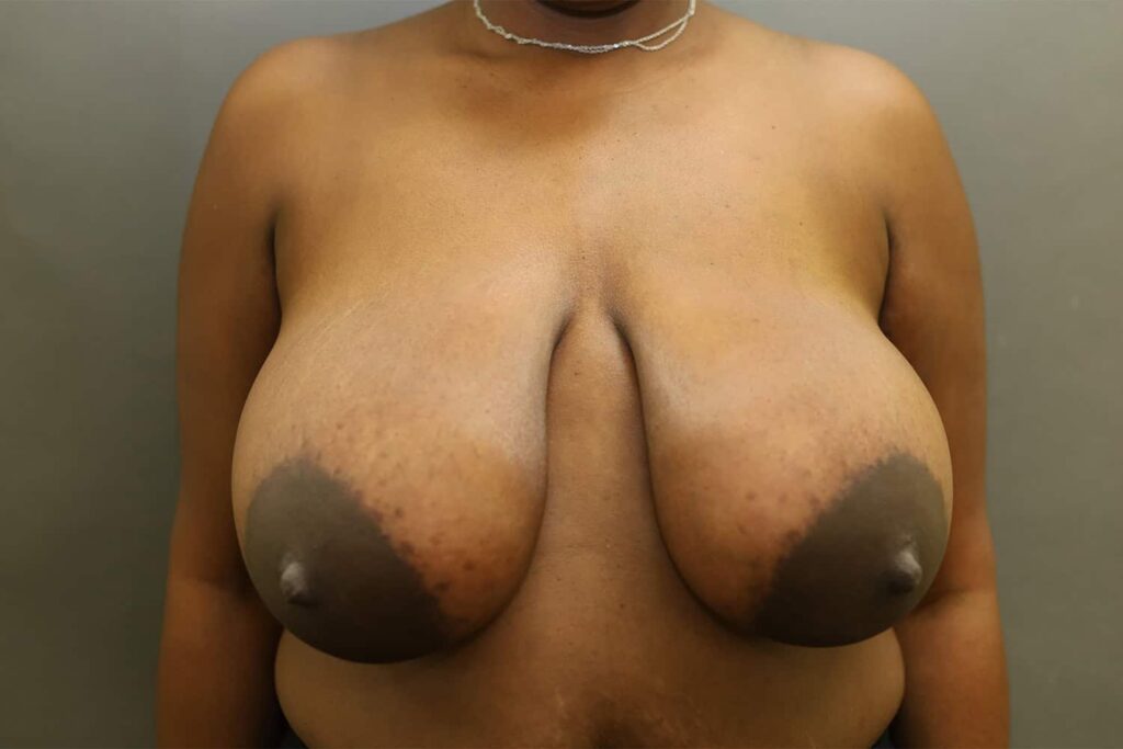 Before Image: Breast Reduction - front