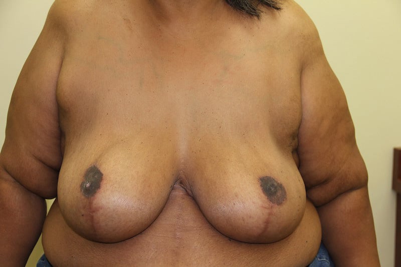 After Image: Breast Reduction - front