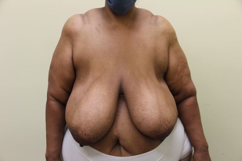 Before Image: Breast Reduction - front