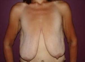 Before Image: Breast Reduction - front