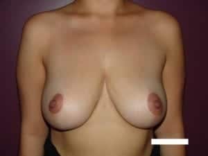 After Image: Breast Reduction - front