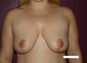 After Image: Breast Reduction - front