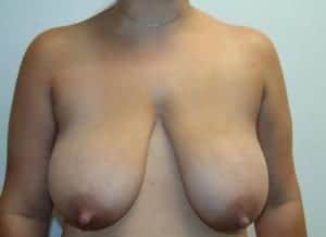 Before Image: Breast Reduction - front