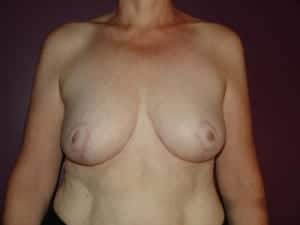 After Image: Breast Reduction - front