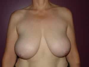 Before Image: Breast Reduction - front