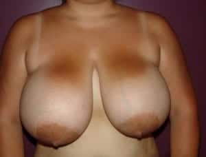 Before Image: Breast Reduction - front