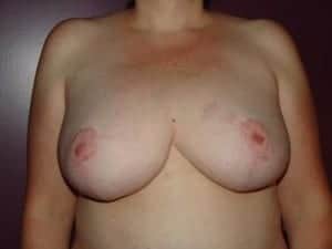 After Image: Breast Reduction - front