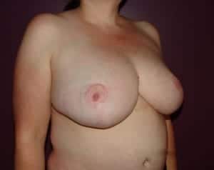 After Image: Breast Reduction - right-front-oblique