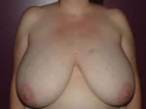 Before Image: Breast Reduction - front