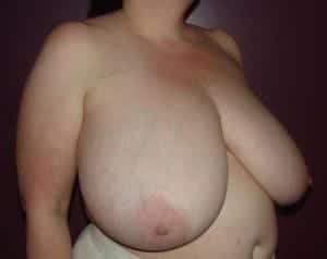 Before Image: Breast Reduction - right-front-oblique