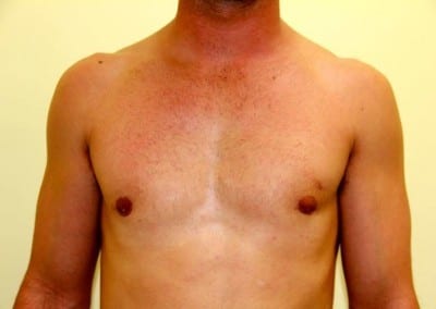 After Image: Breast Reduction for Men - front