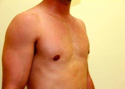 After Image: Breast Reduction for Men - right-front-oblique