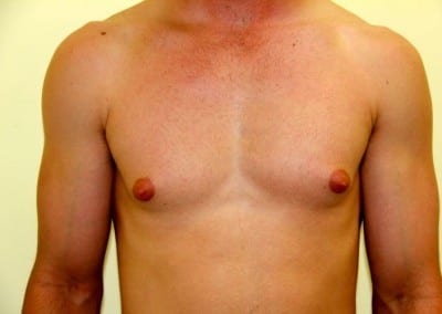 Before Image: Breast Reduction for Men - front