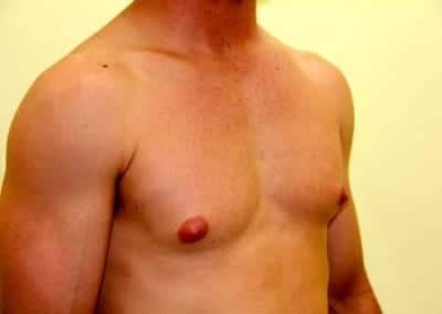 Before Image: Breast Reduction for Men - right-front-oblique