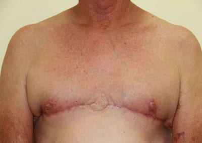 After Image: Breast Reduction for Men - front