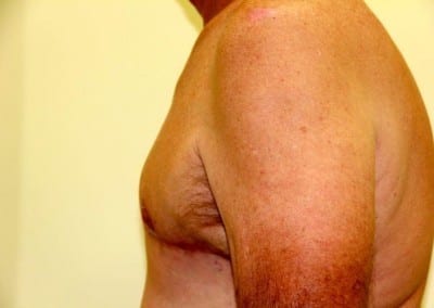 After Image: Breast Reduction for Men - left-side