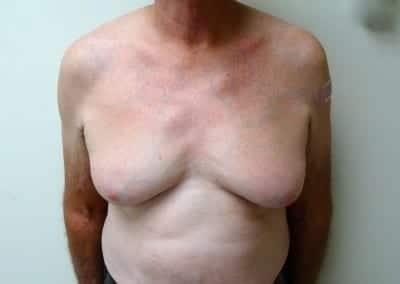 Before Image: Breast Reduction for Men - front