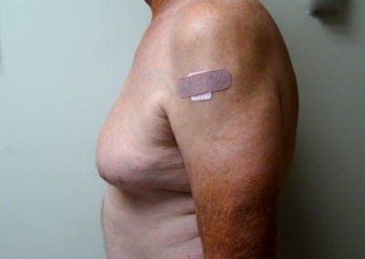 Before Image: Breast Reduction for Men - left-side