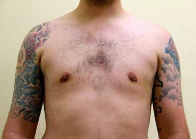 After Image: Breast Reduction for Men - front