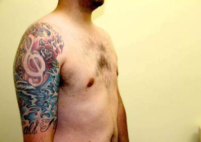 After Image: Breast Reduction for Men - right-front-oblique