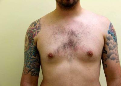 Before Image: Breast Reduction for Men - front