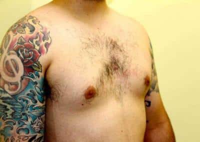 Before Image: Breast Reduction for Men - right-front-oblique